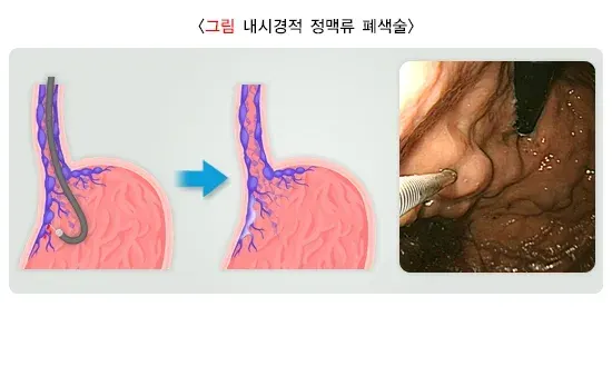간경변증 합병증 설명 이미지 2