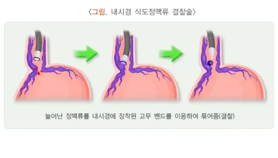 간경변증 합병증 설명 이미지 1