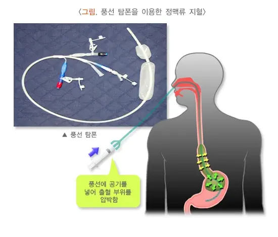 간경변증 합병증 설명 이미지 3