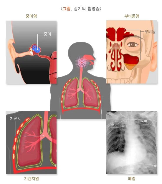 감기 합병증 설명 이미지 1