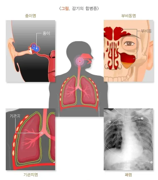 감기 합병증 설명 이미지 1