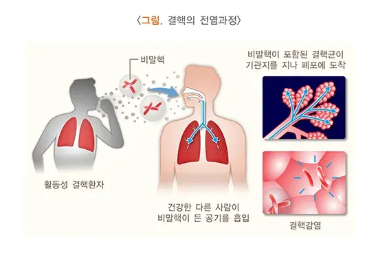 결핵 원인 및 감염경로 설명 이미지 1