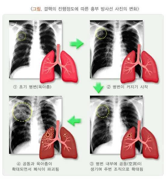 결핵 진단 및 검사 설명 이미지 2