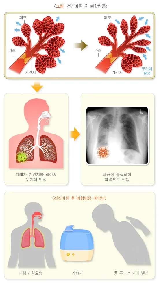 전신마취 치료 관련 합병증 및 부작용 설명 이미지 1