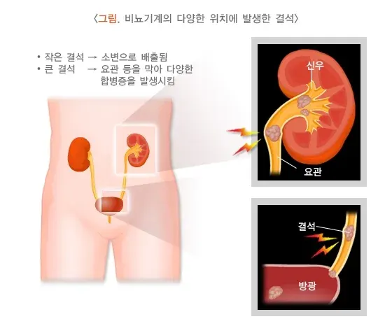 신장결석 정의 설명 이미지 1