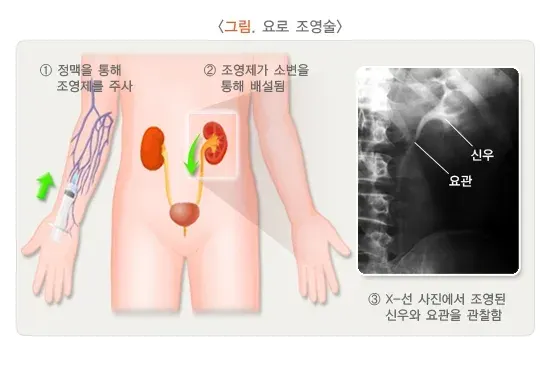 신장결석 진단 및 검사 설명 이미지 3