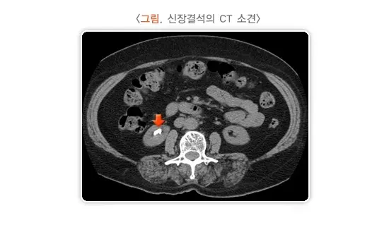신장결석 진단 및 검사 설명 이미지 1
