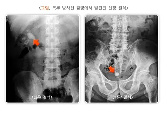 신장결석 진단 및 검사 설명 이미지 2