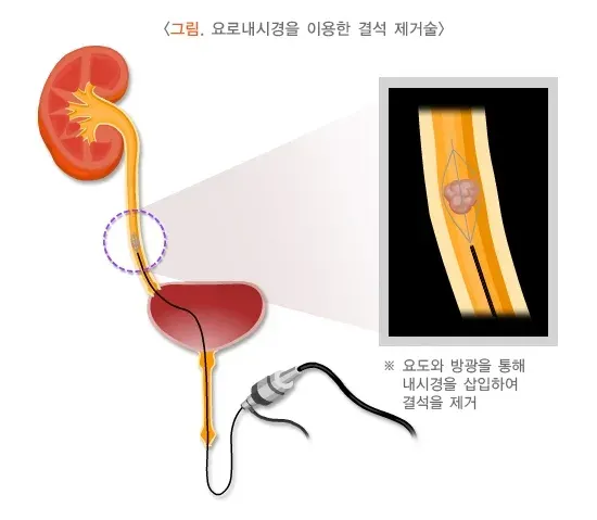 신장결석 치료 설명 이미지 3