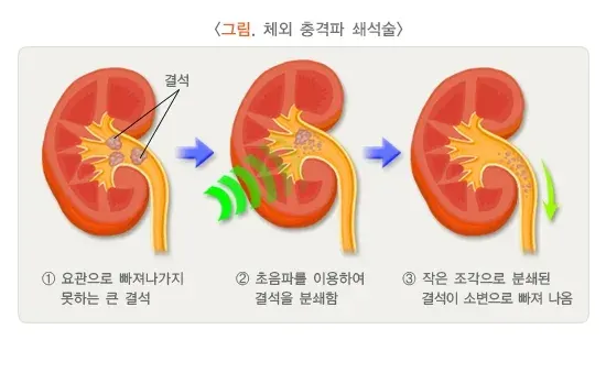 신장결석 치료 설명 이미지 1