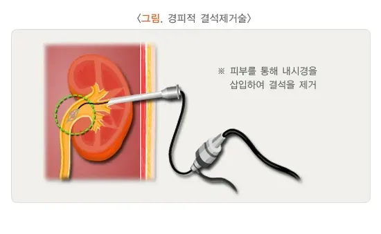 신장결석 치료 설명 이미지 2