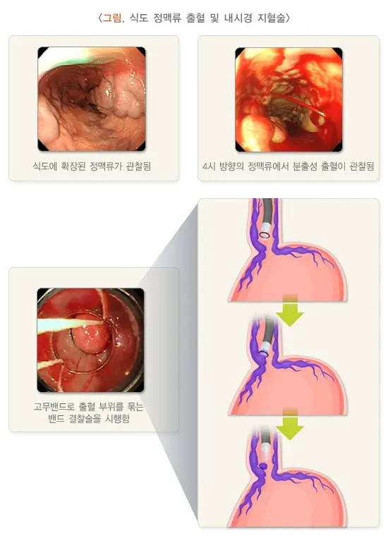 혈변 및 흑변(성인) 원인 설명 이미지 2