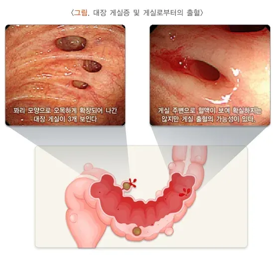 혈변 및 흑변(성인) 원인 설명 이미지 4