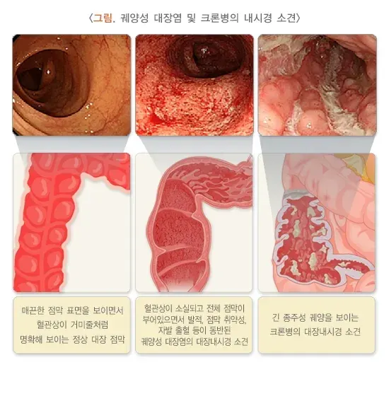 혈변 및 흑변(성인) 원인 설명 이미지 5