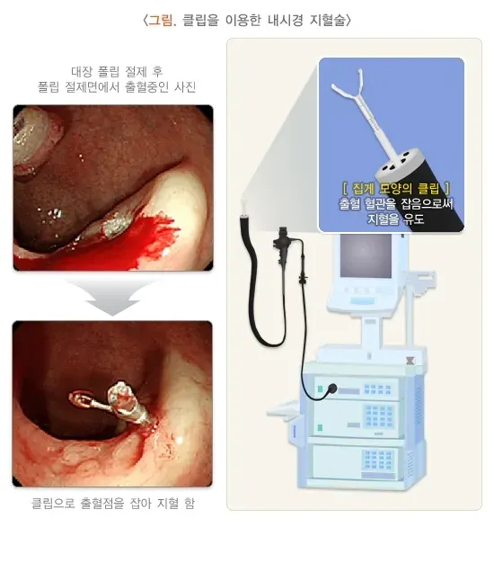 혈변 및 흑변(성인) 치료 설명 이미지 2