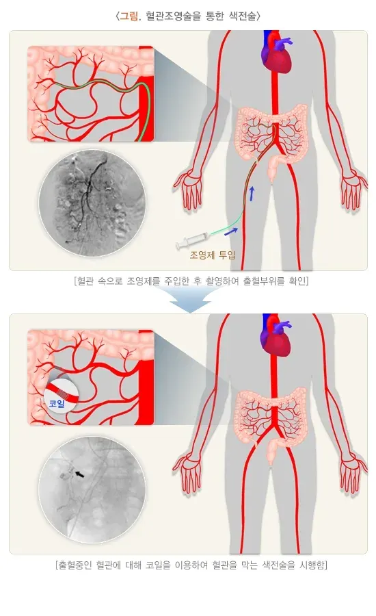 혈변 및 흑변(성인) 치료 설명 이미지 3