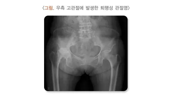 고관절 전치환술 치료의 적응증 설명 이미지 1