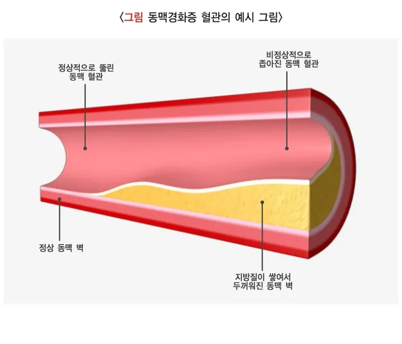 협심증 원인 설명 이미지 1