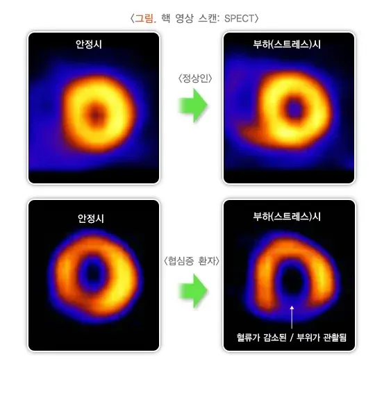 협심증 진단 및 검사 설명 이미지 4