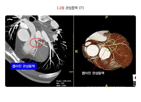 협심증 진단 및 검사 설명 이미지 3