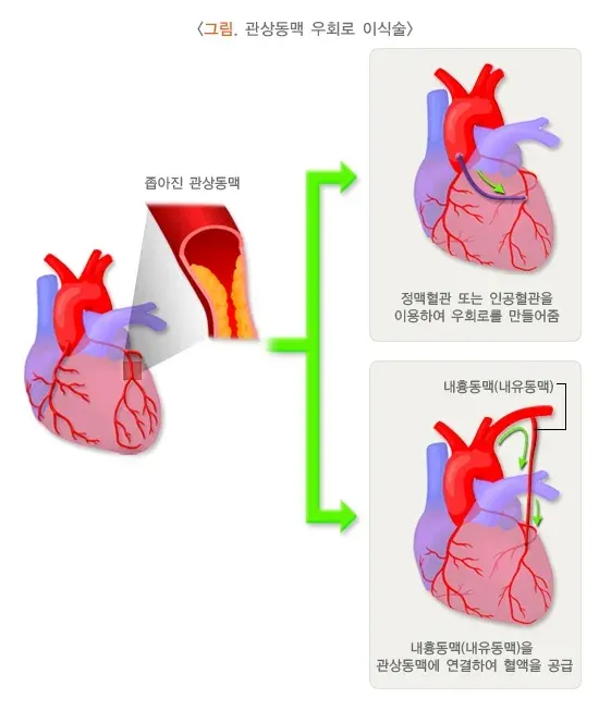 협심증 비약물 치료 설명 이미지 2