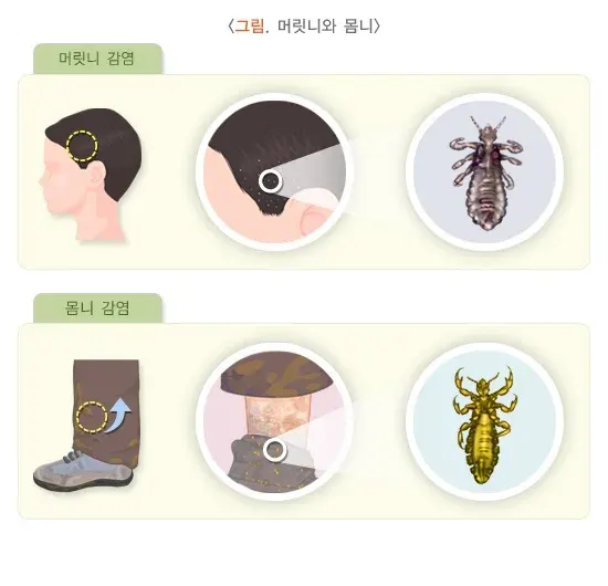이 사면발이 감염증 종류 설명 이미지 1