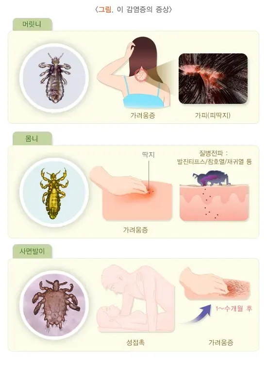 이 사면발이 감염증 증상 설명 이미지 1