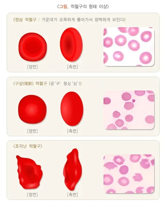 총혈구검사 검사 결과 해석 설명 이미지 5