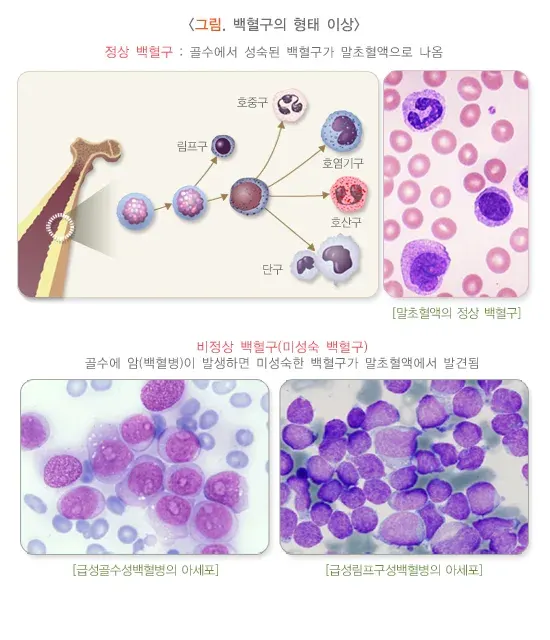 총혈구검사 검사 결과 해석 설명 이미지 6