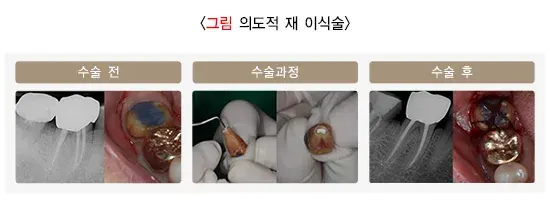 근관치료 치료 방법 설명 이미지 2