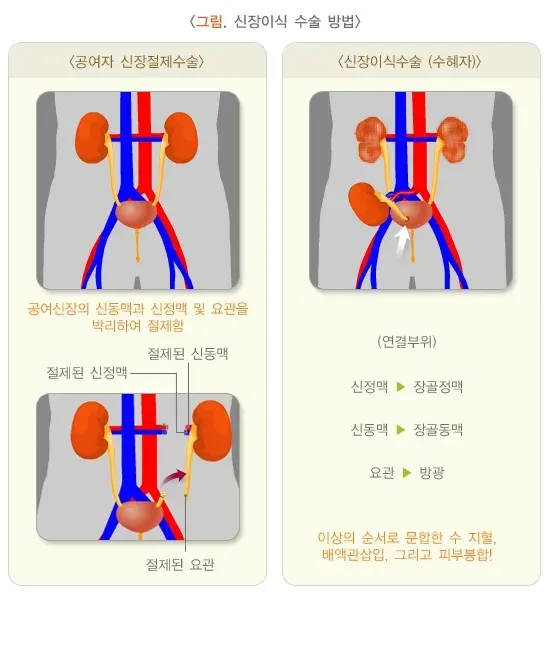 신장 이식 치료 방법 설명 이미지 1