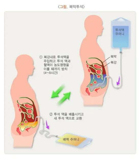 만성콩팥병 치료 설명 이미지 1