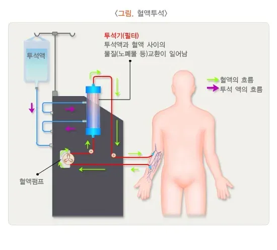 만성콩팥병 치료 설명 이미지 2