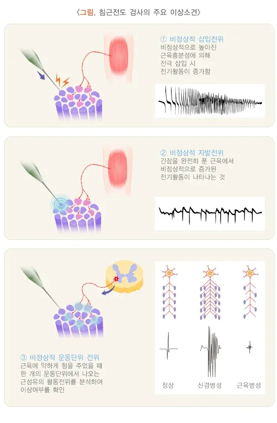 근전도 신경전도검사 검사 결과 해석 설명 이미지 2