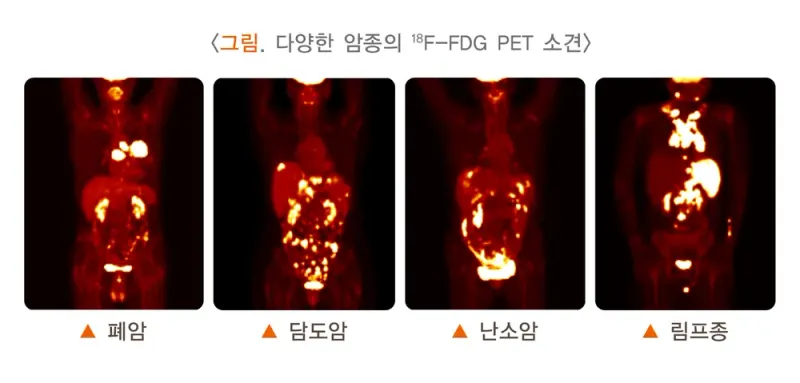 양전자방출단층촬영술 검사 목적 설명 이미지 1