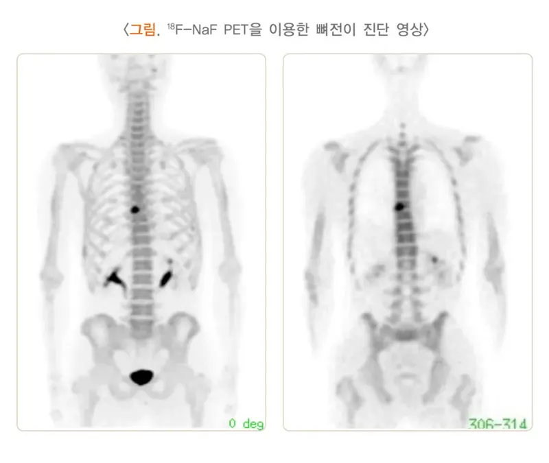 양전자방출단층촬영술 검사 목적 설명 이미지 3