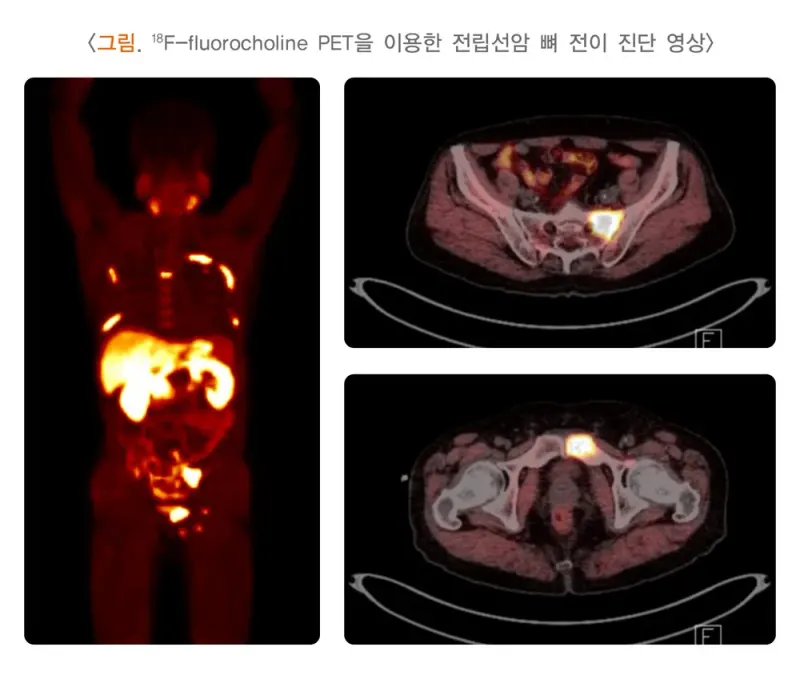 양전자방출단층촬영술 검사 목적 설명 이미지 4