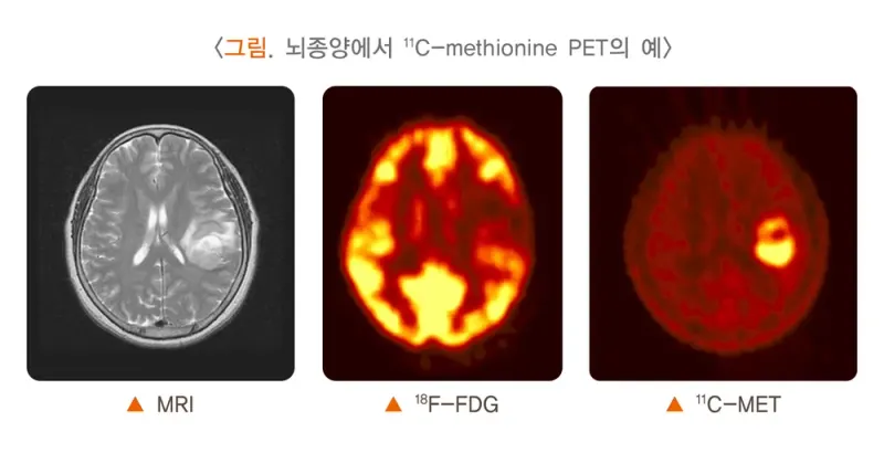 양전자방출단층촬영술 검사 목적 설명 이미지 2