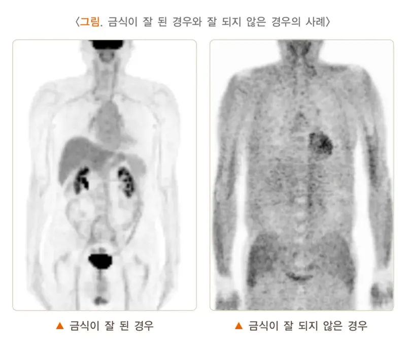 양전자방출단층촬영술 검사 준비 설명 이미지 2