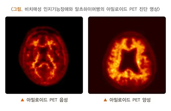 양전자방출단층촬영술 검사 결과 해석 설명 이미지 2