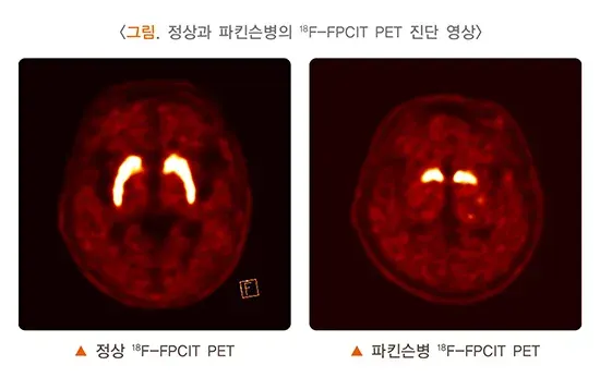 양전자방출단층촬영술 검사 결과 해석 설명 이미지 3