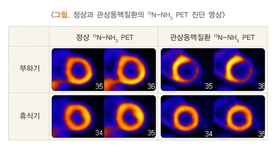 양전자방출단층촬영술 검사 결과 해석 설명 이미지 4