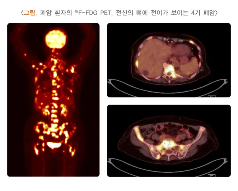양전자방출단층촬영술 검사 결과 해석 설명 이미지 1