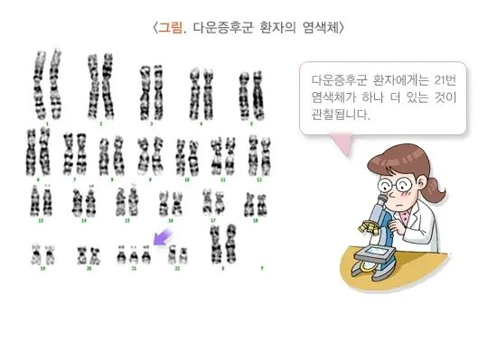 다운증후군 정의 설명 이미지 1