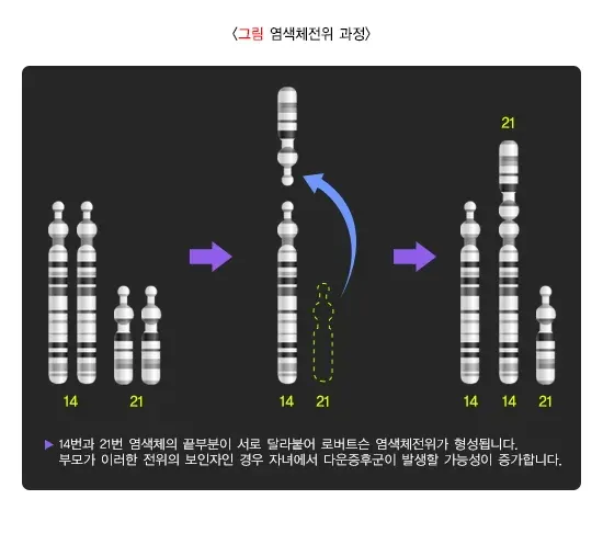 다운증후군 원인 설명 이미지 1