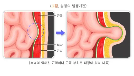 탈장 정의 설명 이미지 1