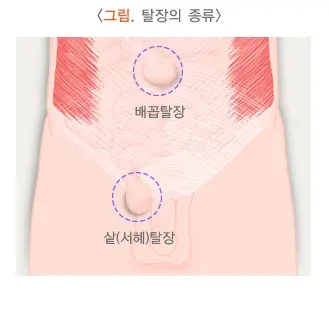 탈장 종류 설명 이미지 1