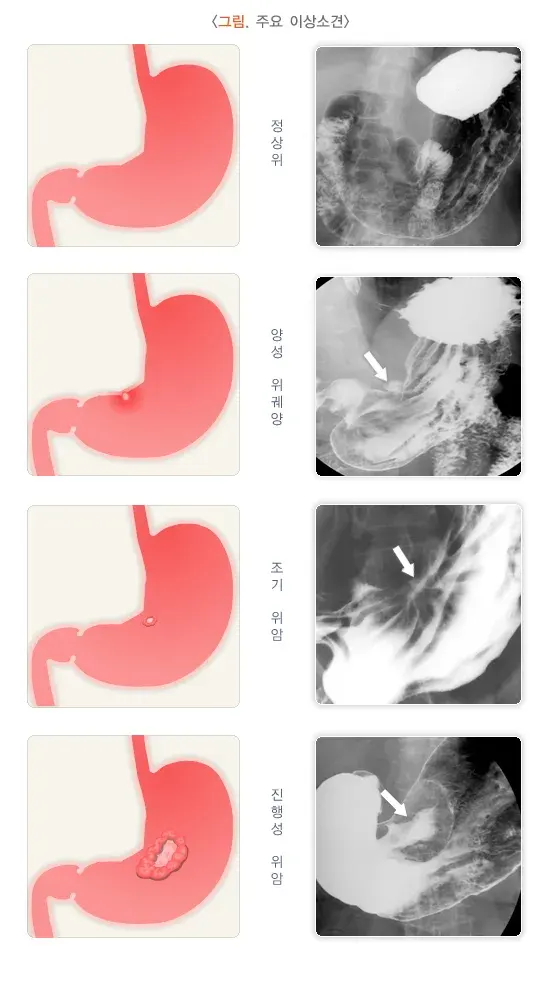 상부위장관 촬영 검사 결과 해석 설명 이미지 1