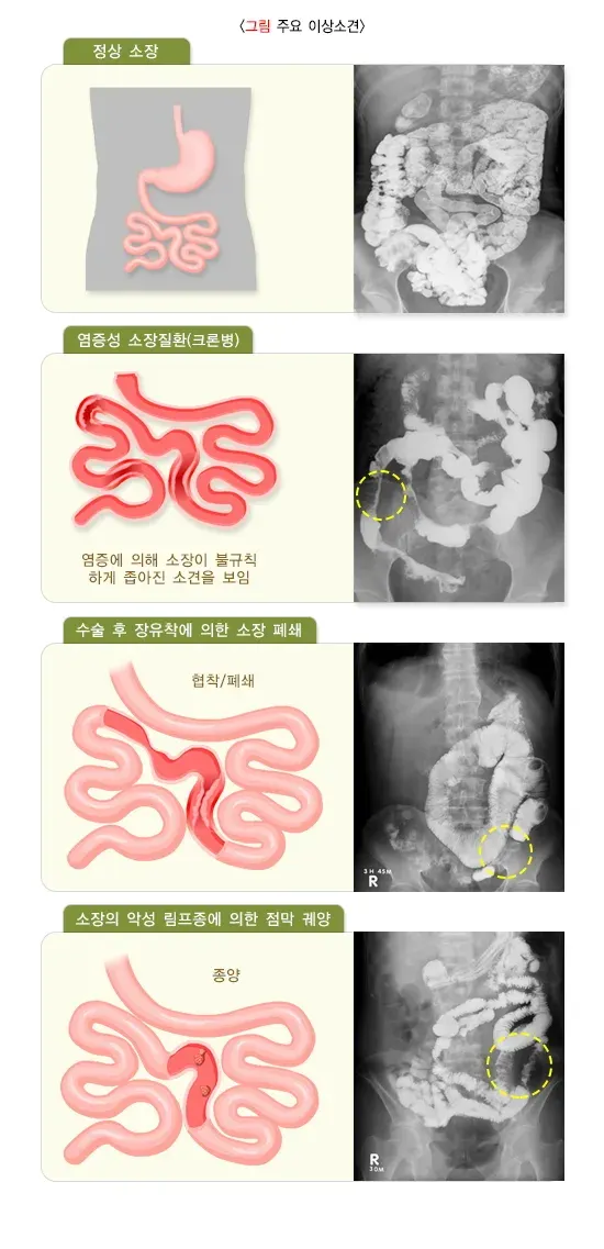 소장 촬영 검사 결과 해석 설명 이미지 1