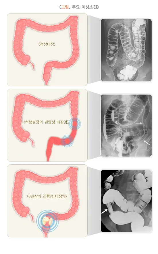 하부위장관 촬영 검사 결과 해석 설명 이미지 1